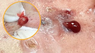 Cystic acne treatment I Điều trị mụn nang hiệu quả số 1 Hiền Vân Spa I Huỳnh Việt Hồ I Part 2 I 494