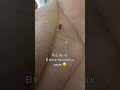 liceinfestation970 #headliceremoval #licecomb #headlice #headlicetreatment #hairlice #haircare #hair