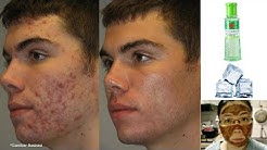 7 Cara Menghilangkan Jerawat Dalam Satu Hari | How To Get Rid Of Pimples - Durasi: 5.07. 