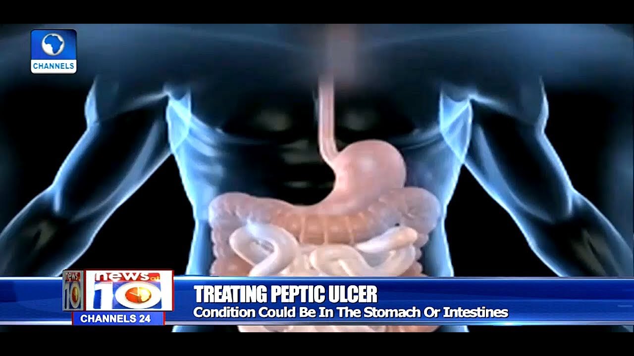 How To Treat Peptic Ulcer |Health Focus|