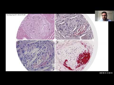 Video: Amyloidosis Terkait Autosomal Dominan Transthyretin (TTR) Bukanlah Neuropati CMT2 Yang Sering “menyamar”