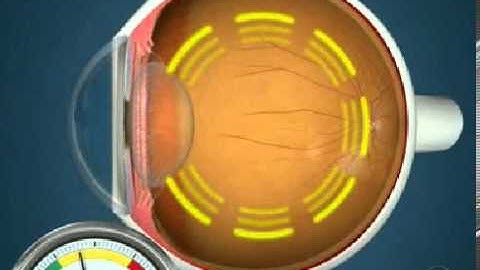 Glaucoma