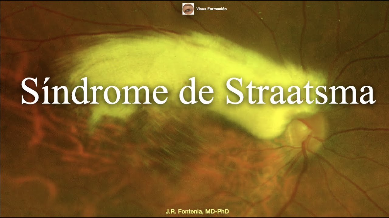 Síndrome de Straatsma. Miopía, Ambliopía y Mielinizacion de capa de fibras nerviosas retinianas.