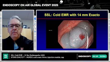 Endoscopy On Air 2025 | Dr. Douglas Rex: EXACTO™ - MUNDO Cold Snare Clinical Overview