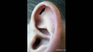 Le Tubercule De Darwin