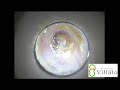 耳掃除 vol.14「奥に押し込んじゃいました」(ear wax removal)イヤーエステサロンVillalo～ヴィラロ～