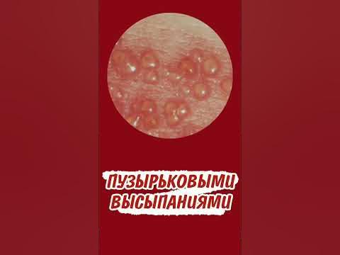 Все о герпесе - YouTube