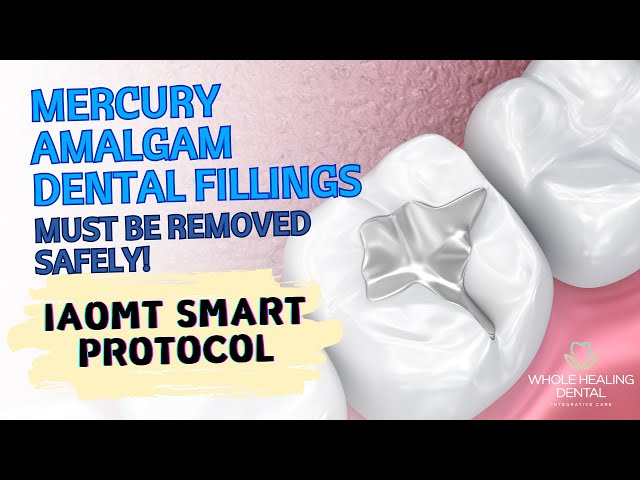 IAOMT SMART Protocol - Mercury Amalgam Dental Fillings must be removed safely! class=
