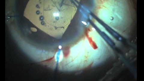 Small pupil with iris hooks-With Audio.