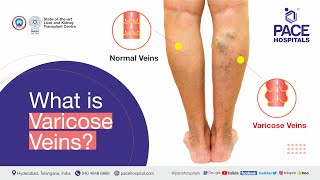 What is Varicose Vein | Varicose Veins Explained - Cause, Symptoms, Complications & Treatments