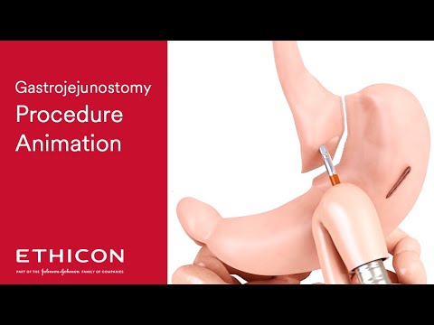 Intraluminal Circular Stapler Gastrojejunostomy Procedure | Ethicon