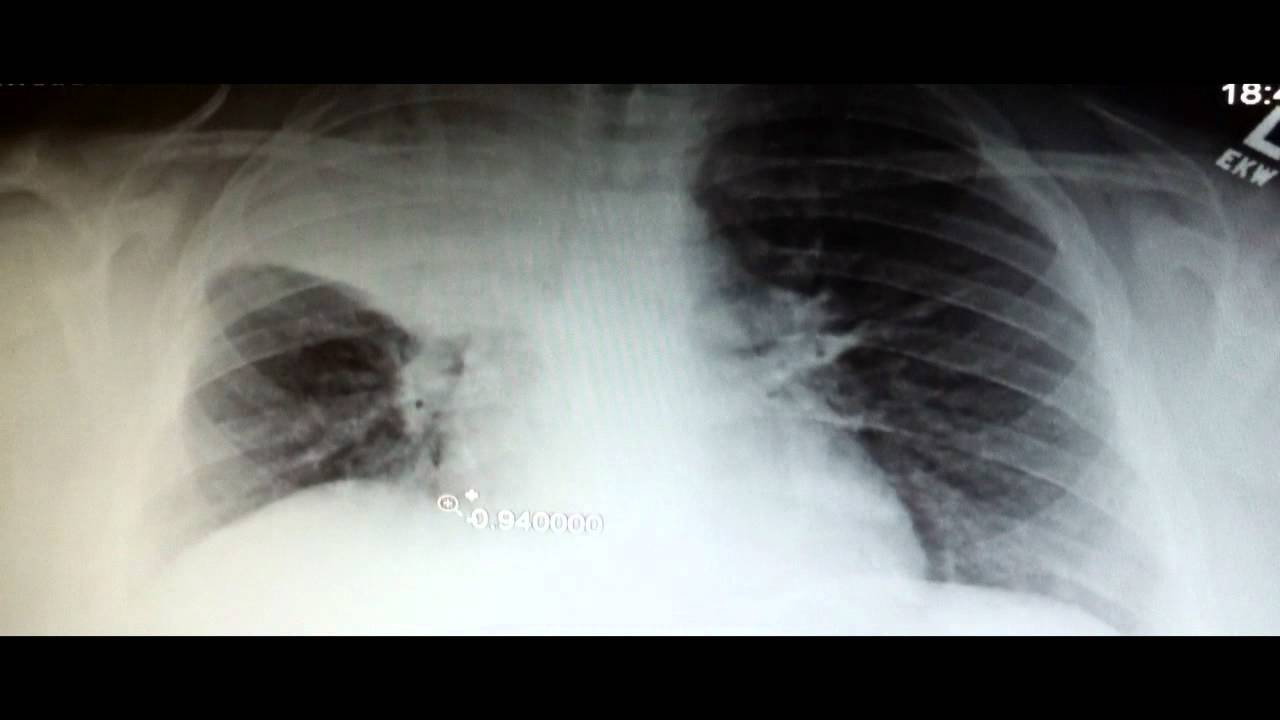 Pneumonia On Chest X