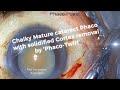 Chalky mature cataract phaco with solidified cortex removal by the  phaco twirl manoeuver