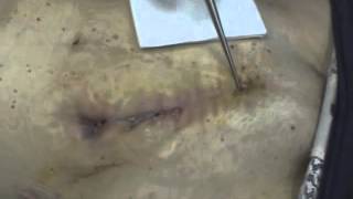 Video 52 - Převaz Rány, Píštěl V Laparotomii