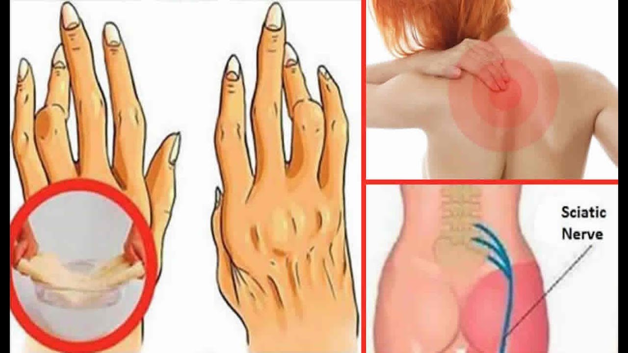remedios naturales para la artritis Esto elimina el dolor de artritis, dolor de espalda y ciática. ¡Funciona mejor que las pastillas!