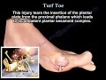 Turf Toe  ,Big toe pain - Everything You Need To Know - Dr. Nabil Ebraheim