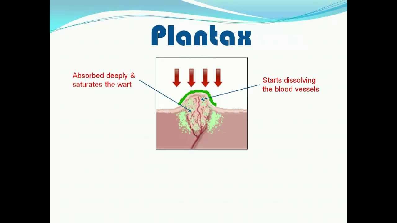 Get Rid of Plantar Warts in 2-4 weeks flat - YouTube