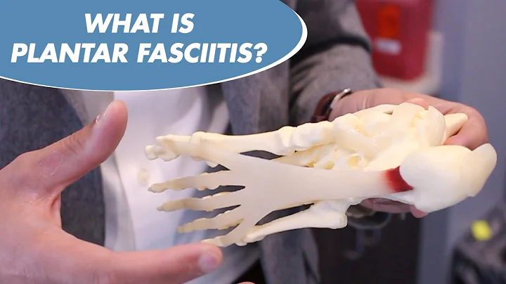 WHAT IS PLANTAR FASCIITIS? HOW DO YOU TREAT IT? - DR. AMMAR SAYMEH FOOT AND ANKLE SPECIALIST