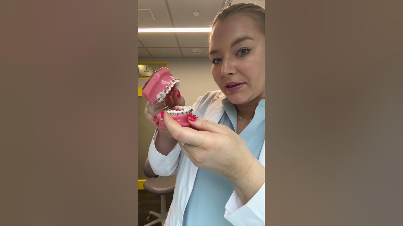 How to fix lock jaw at home! lockjaw braces video cred Sinatra YouTube