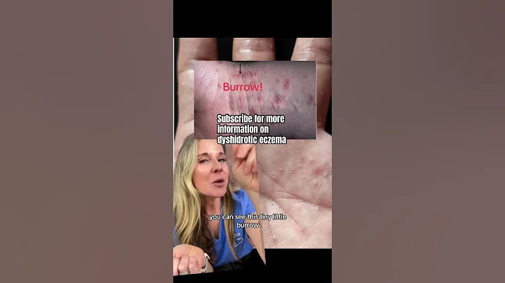 Do you have dyshidrotic eczema? 🖐️#shorts #dyshidroticeczema