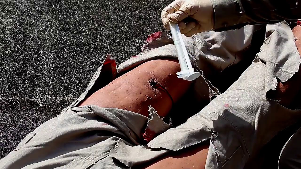 XSTAT for Stopping Severe Bleeding in the Leg