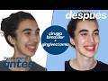Corrección de sonrisa gingival | cirugía ortognática | antes y después de una paciente real.