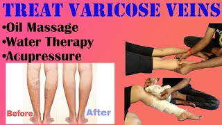 Varicose Veins Causes, Symptoms and Treatment