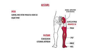 Piriformis Syndrome (buttock pain, siatica) by Armando Hasudungan 45,737 views 7 months ago 8 minutes, 46 seconds