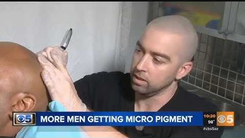 3TV and CBS coverage of Scalp Micropigmentation by DermiMatch
