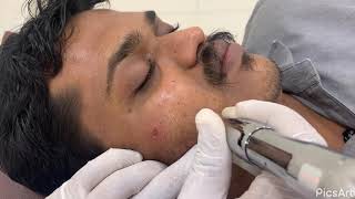 Microneedling Treatment For Chicken Pox Scar Marks On Skin by Dr. Vaseem Choudhary screenshot 5