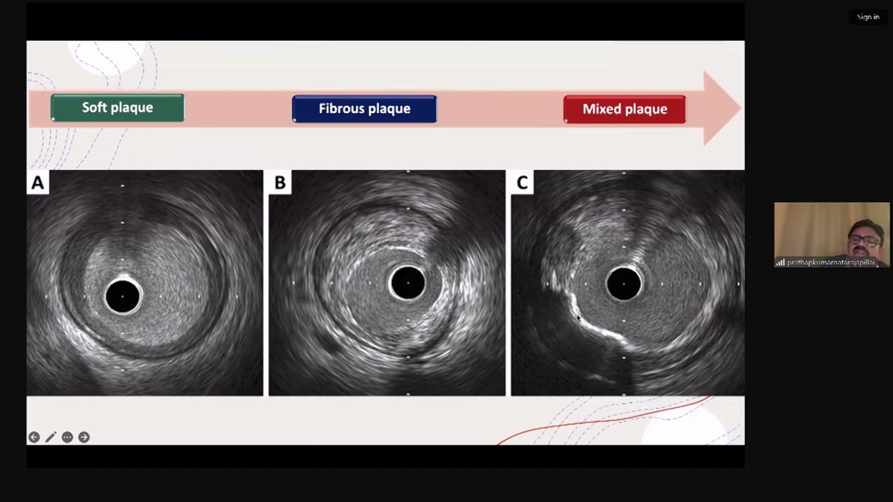 LEARN IVUS