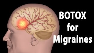 BOTOX for Migraines, Animation.