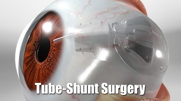 Het afvoeren van vocht om drukopbouw door glaucoom te voorkomen