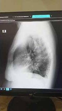 Cardiomegaly disertai Aortosclerosis Severe Wedge Shape Compression Fracture Corpus VTH 6