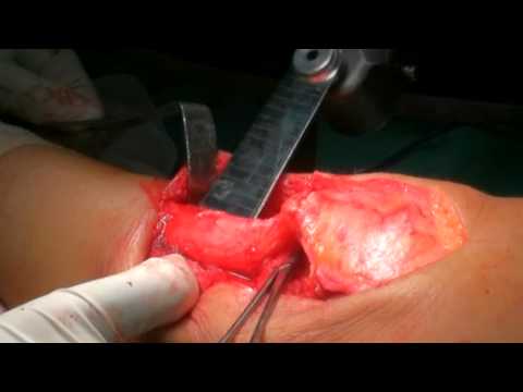 CHONDROCYTE IMPLANTATION. Dr. George GOUDELIS