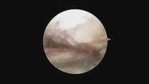 Arthroscopic Tarsometatarsal Arthrodesis
