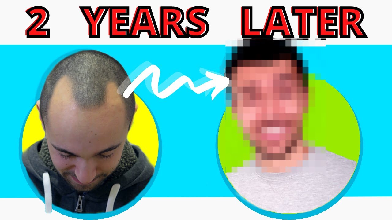 How Does TRANSPLANTED HAIR Look Like After 2 YEARS Before After