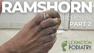 10 Ramshorns vs 1 Podiatrist (PART 2)