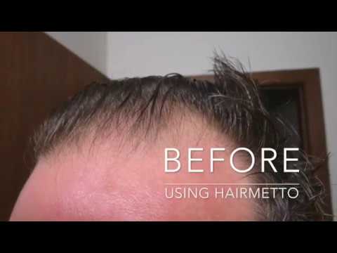 Testimonial For Hairmetto Natural Hair Loss Treatment Youtube