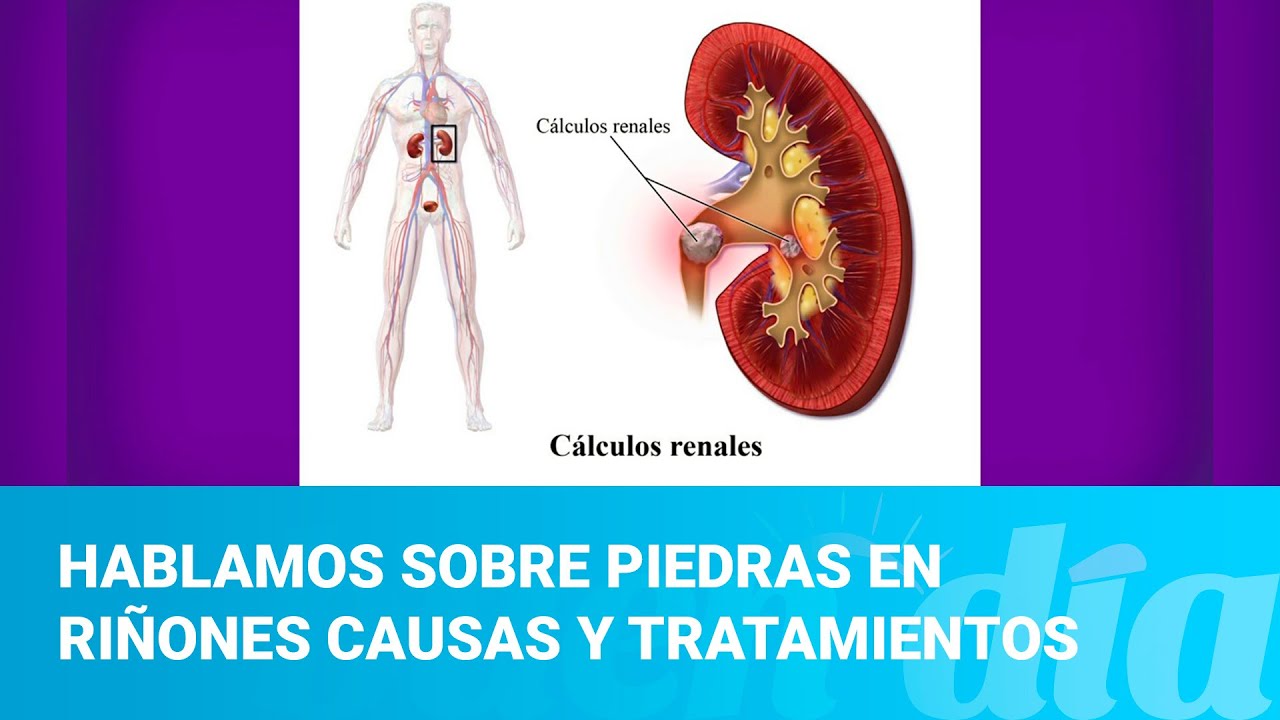 Hablamos sobre piedras en riñones causas y tratamientos - YouTube