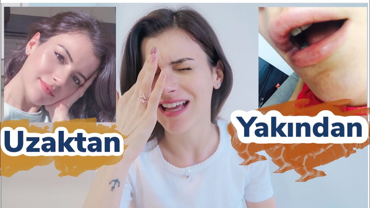 dudak dolgumu neden erittim?