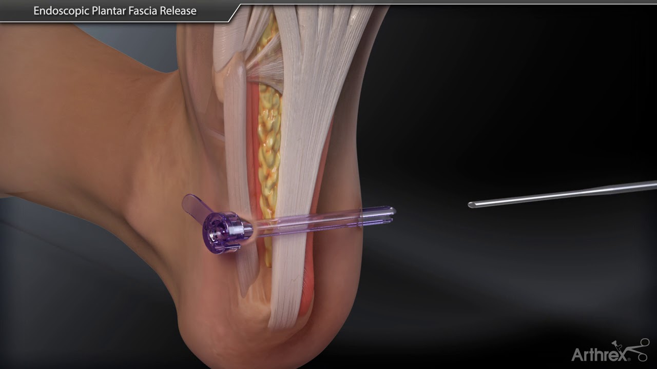 Endoscopic Plantar Fascia Release YouTube