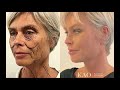 Dr kao ponytail facelift in denmark at alerishamlet english subtitles