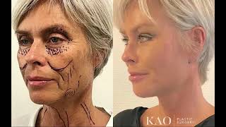 Dr. Kao Ponytail Facelift in Denmark at AlerisHamlet (English Subtitles)