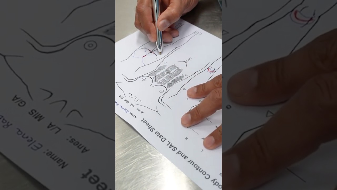 Cirugía Combinada | Lifting de Rodillas + Ninfoplastia + Aumento Glúteo ✨