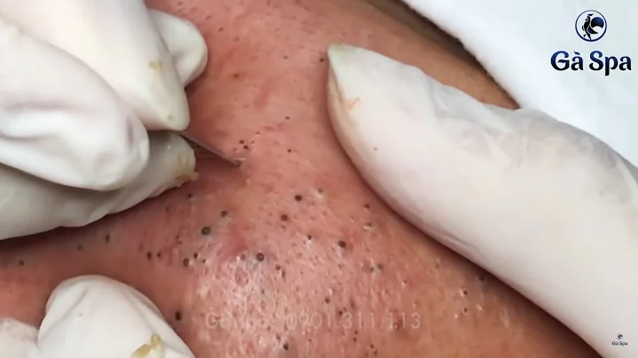 Best Blackhead Removal Ever 55min - Facial Acne Treatment - Gà Spa - DayDayNews