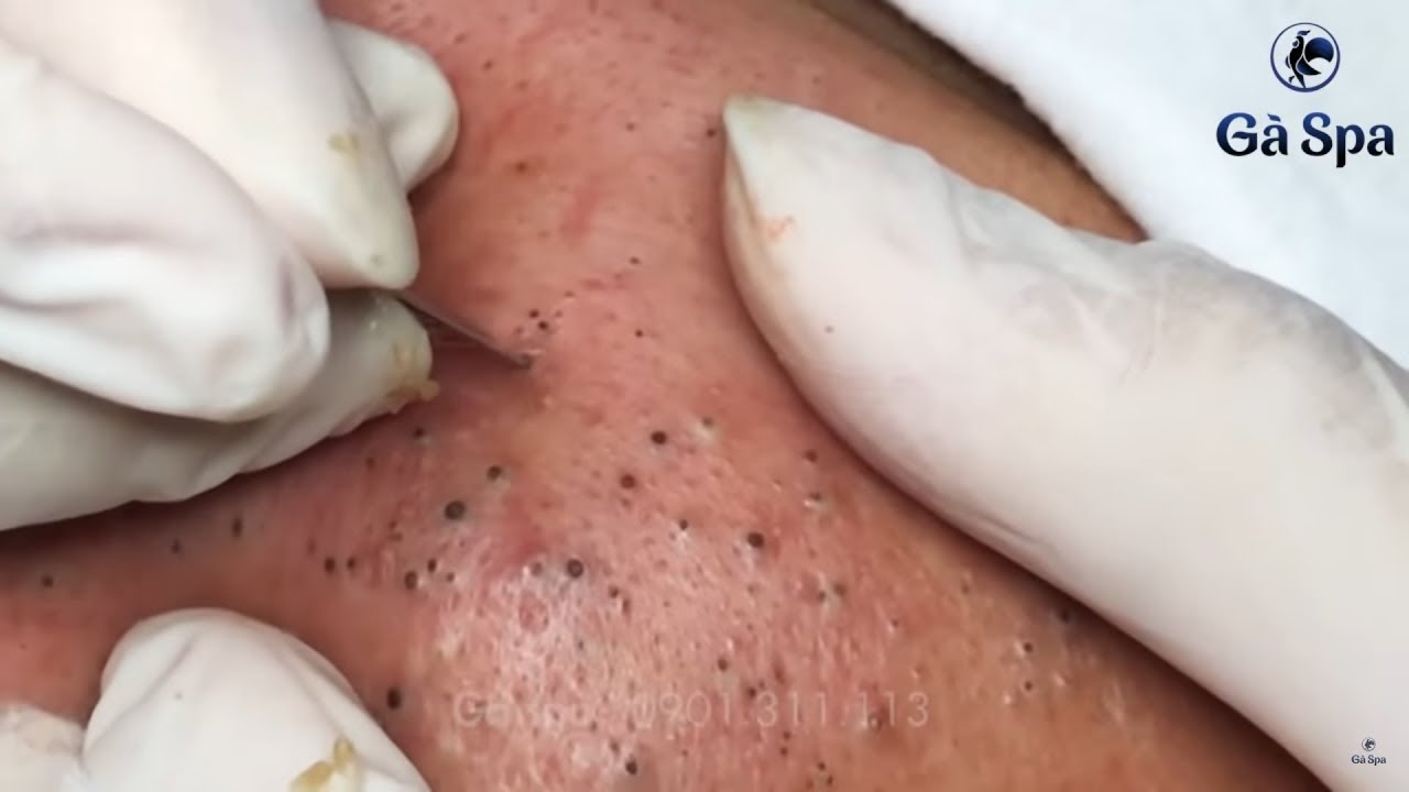 Big Cystic Acne Blackheads Extraction Blackheads \u0026 Milia, Whiteheads Removal Pimple Popping