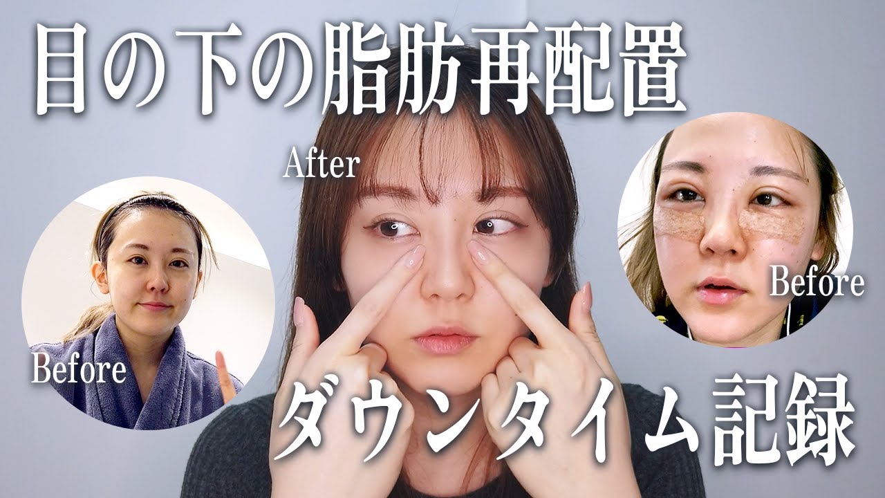 【目の下の脂肪再配置】クマ取りダウンタイム3日目が地獄だった…リアルダウンタイム経過記録