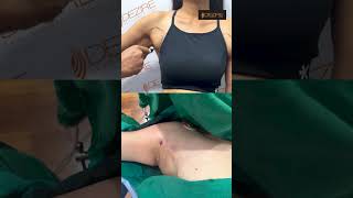 Axillary Fat Removal