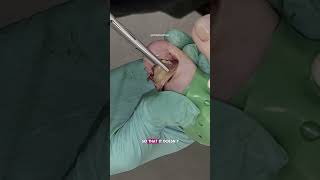 Severely thickened nail (onychauxis) removal 👣😳